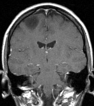 Fig 1, Oligodendroglioma. T1-weighted MRI showing hypodense, noncontrast-enhancing lesion.