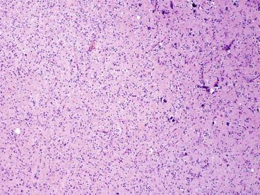 Fig 2, Oligodendroglioma. Low-magnification view showing an infiltrating, monomorphous-appearing tumor with focal microcalcifications ( right ).