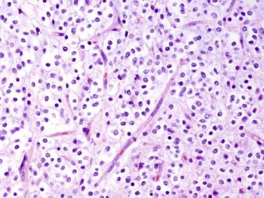 Fig 4, Oligodendroglioma. Chicken wire–like capillaries are a distinctive feature.