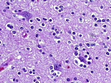 Fig 5, Oligodendroglioma. Perineuronal “satellitosis” is typically seen with gray matter infiltration.