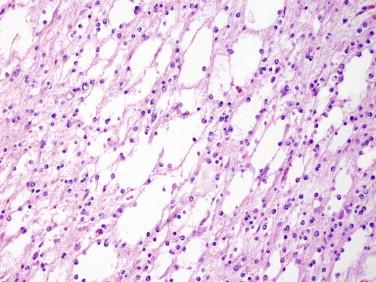 Fig 6, Oligodendroglioma. Microcytic changes may be prominent.