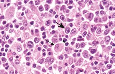 Figure 23-2, Diffuse large B-cell lymphoma: nuclear size assessment.