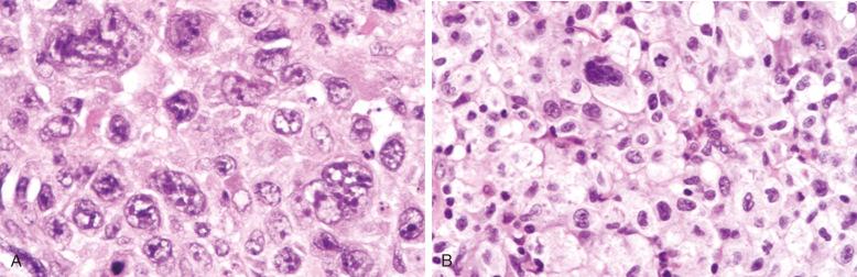 Figure 23-12, Diffuse large B-cell lymphoma with cells that are difficult to classify.