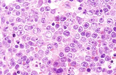 Figure 23-13, Diffuse large B-cell lymphoma, centroblastic subtype.