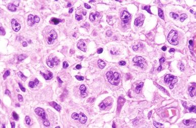 Figure 23-14, Diffuse large B-cell lymphoma, anaplastic subtype.