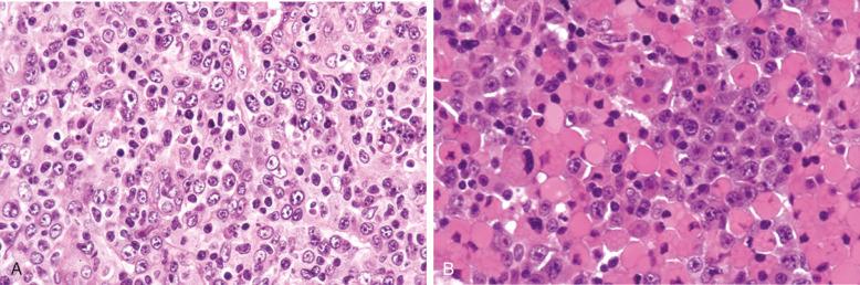 Figure 23-15, Diffuse large B-cell lymphoma with plasma cell differentiation.