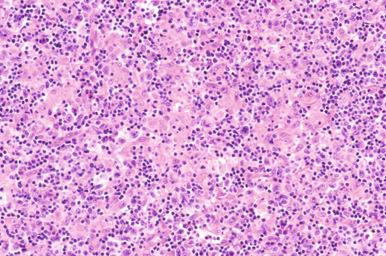 Figure 23-16, Diffuse large B-cell lymphoma with many interspersed small clusters of epithelioid histiocytes, reminiscent of Lennert's (lymphoepithelioid) T-cell lymphoma.