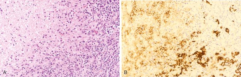 Figure 23-17, Diffuse large B-cell lymphoma presenting as lymph node infarction.