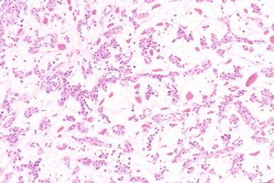 Figure 23-18, Diffuse large B-cell lymphoma with abundant myxoid stroma, mimicking extraskeletal myxoid chondrosarcoma.