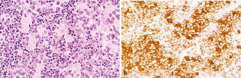 Figure 23-20, Diffuse large B-cell lymphoma with fibrillary matrix.