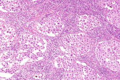 Figure 23-21, Sinusoidal CD30-positive diffuse large B-cell lymphoma.