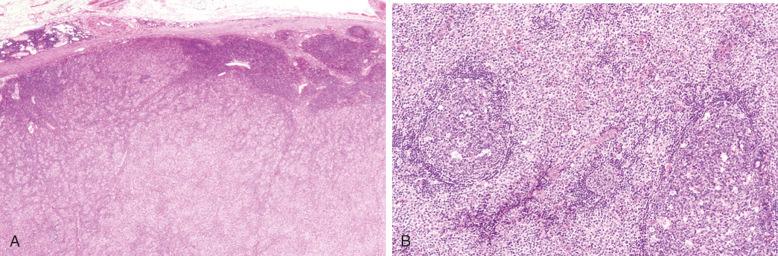 Figure 23-3, Nodal diffuse large B-cell lymphoma.