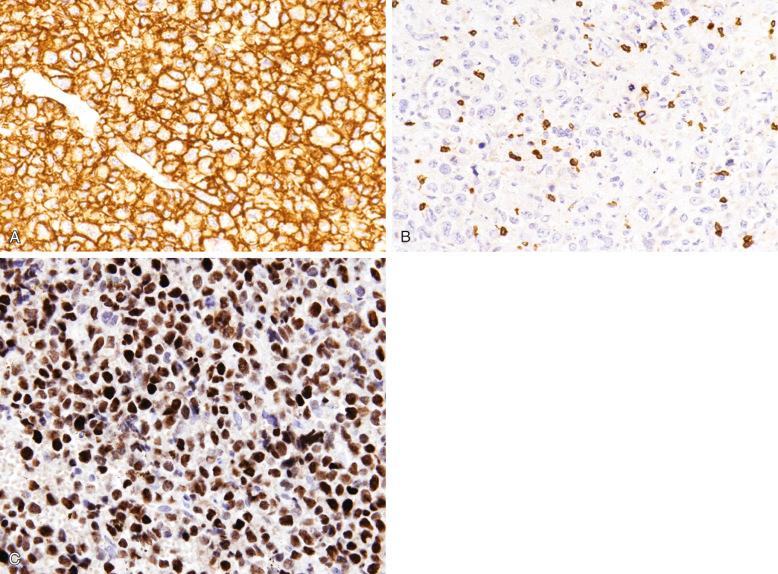 Figure 23-22, Immunohistochemistry of diffuse large B-cell lymphoma.