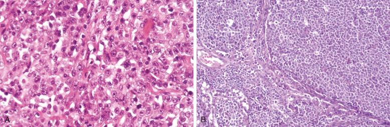 Figure 23-4, Nodal diffuse large B-cell lymphoma.