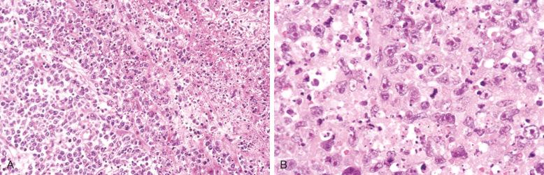 Figure 23-5, Diffuse large B-cell lymphoma.