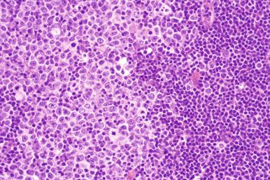 Figure 23-7, Diffuse large B-cell lymphoma arising in chronic lymphocytic leukemia (Richter's syndrome).