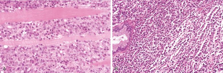 Figure 23-8, Extranodal diffuse large B-cell lymphoma.