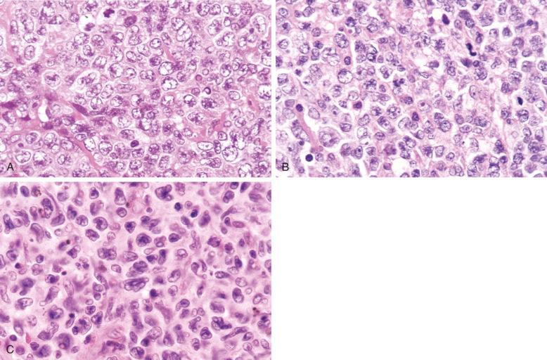 Figure 23-9, Diffuse large B-cell lymphoma, centroblastic (large non-cleaved cell) subtype.