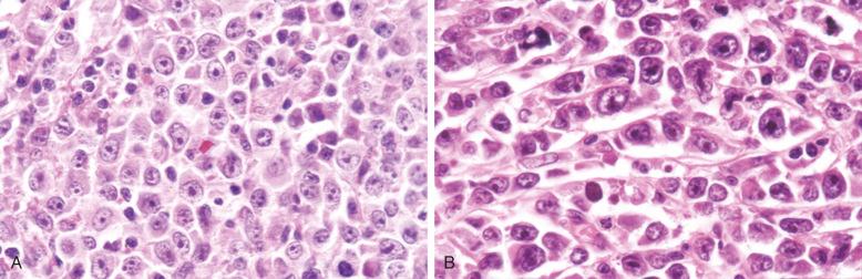 Figure 23-10, Diffuse large B-cell lymphoma, immunoblastic subtype.