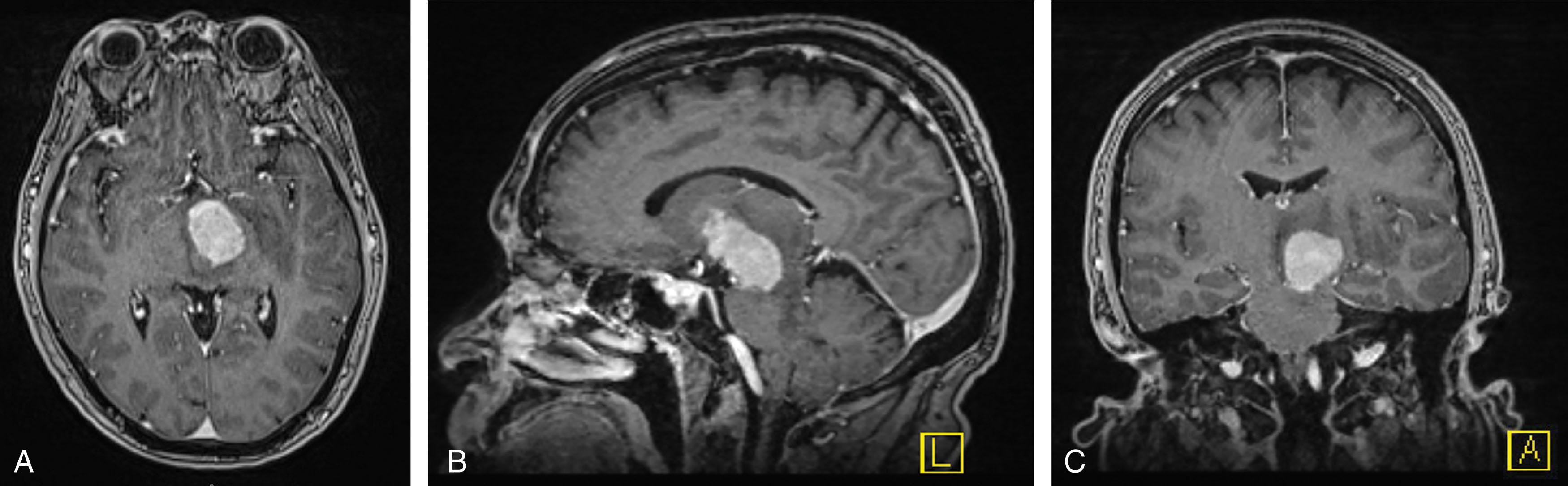 Figure 84.2, PRIMARY CENTRAL NERVOUS SYSTEM LYMPHOMA IN IMMUNOCOMPETENT INDIVIDUAL.