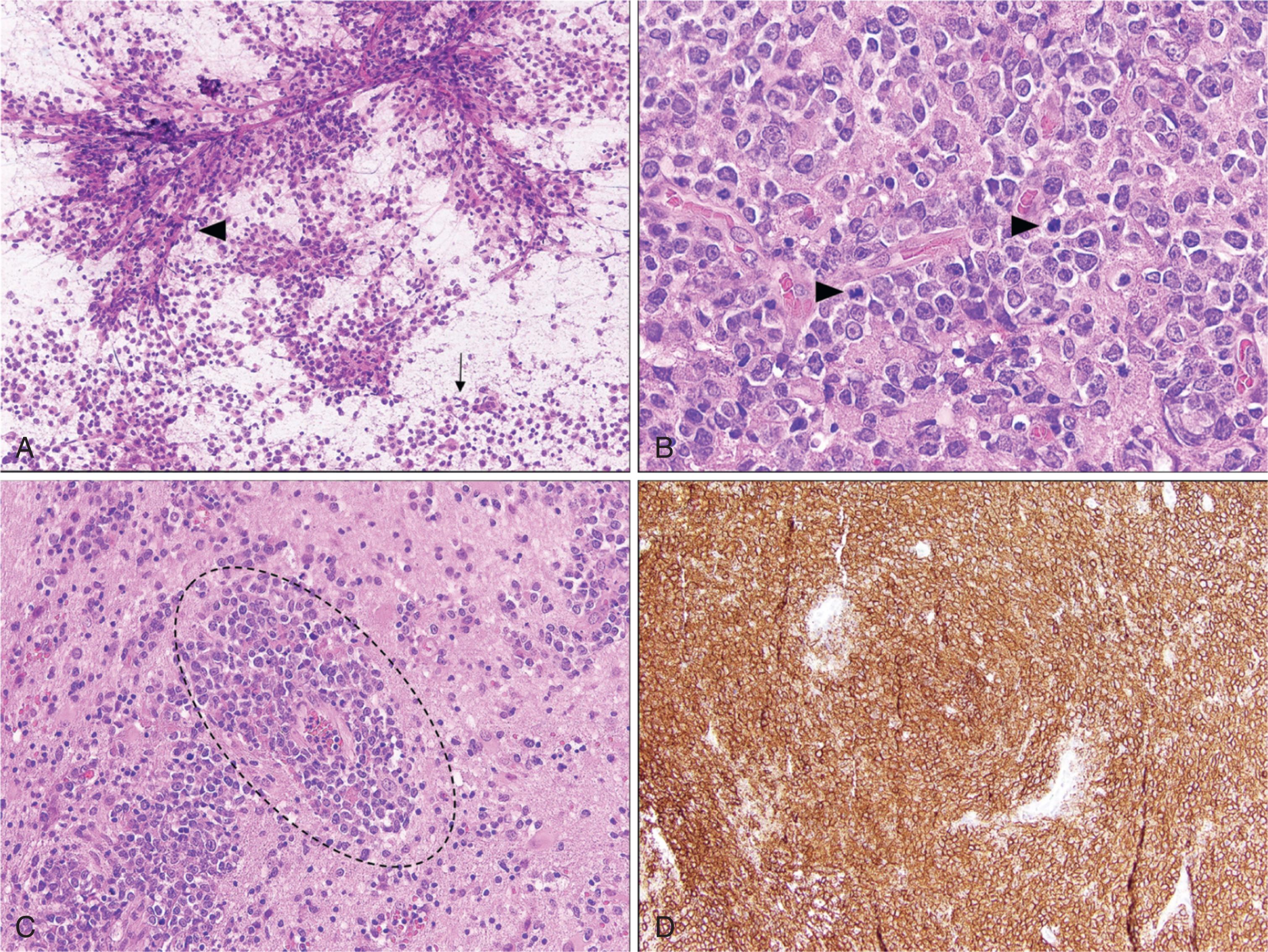 Figure 84.6, DIFFUSE LARGE B-CELL LYMPHOMA OF THE CENTRAL NERVOUS SYSTEM.