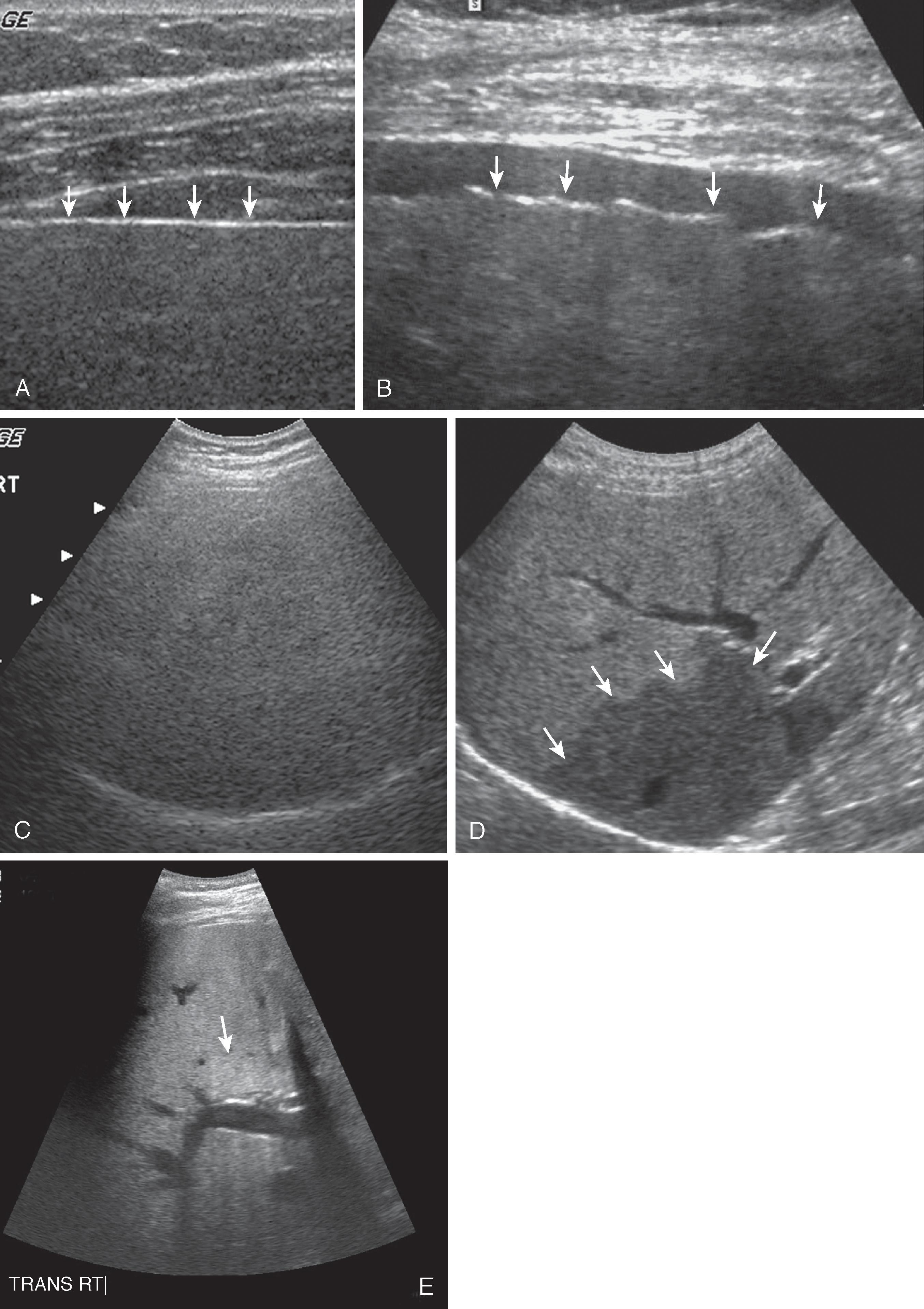 Fig. 56.1, Hepatic steatosis: spectrum of sonographic findings.