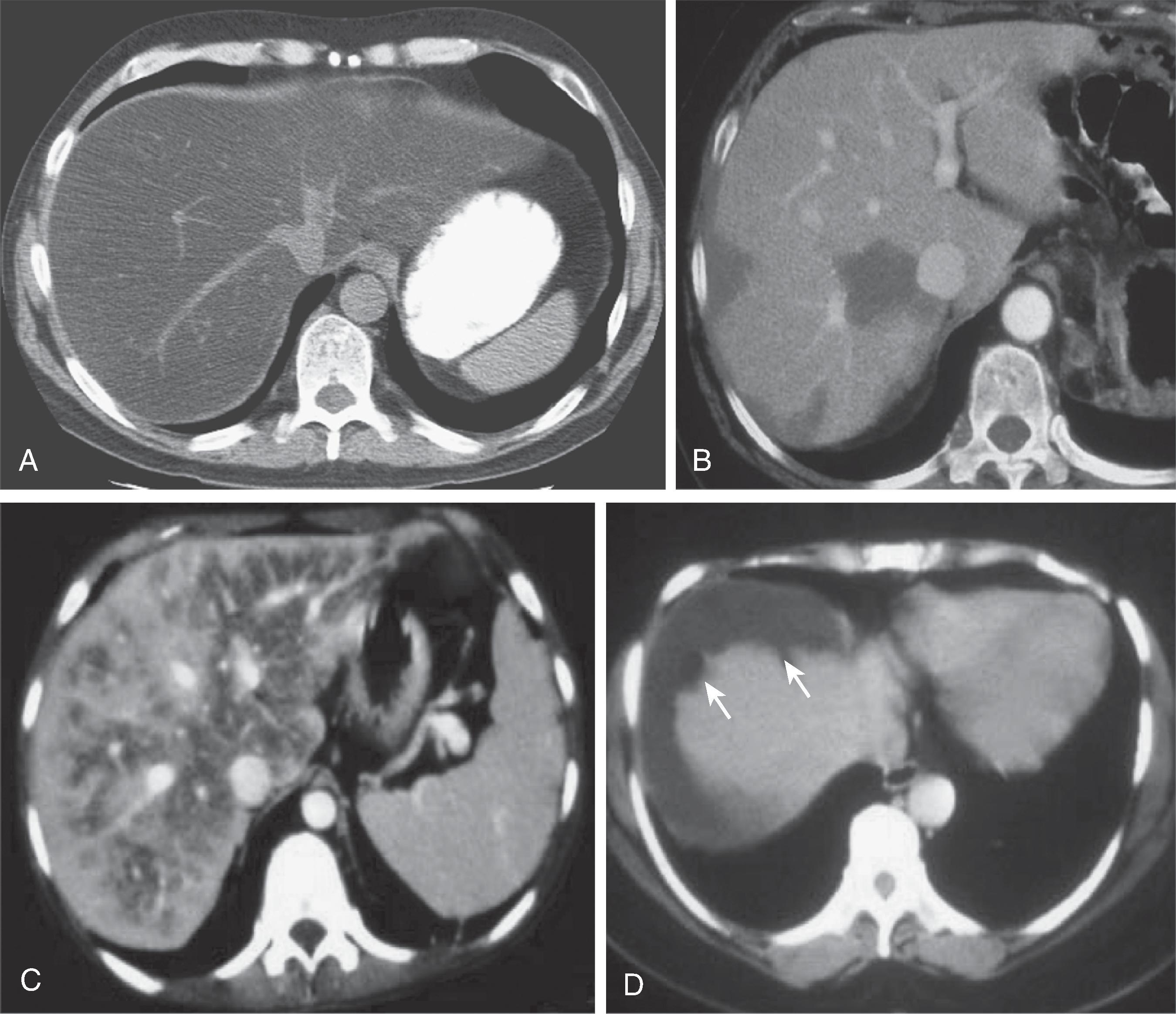 Fig. 56.2, Hepatic steatosis: spectrum of computed tomography (CT) findings.