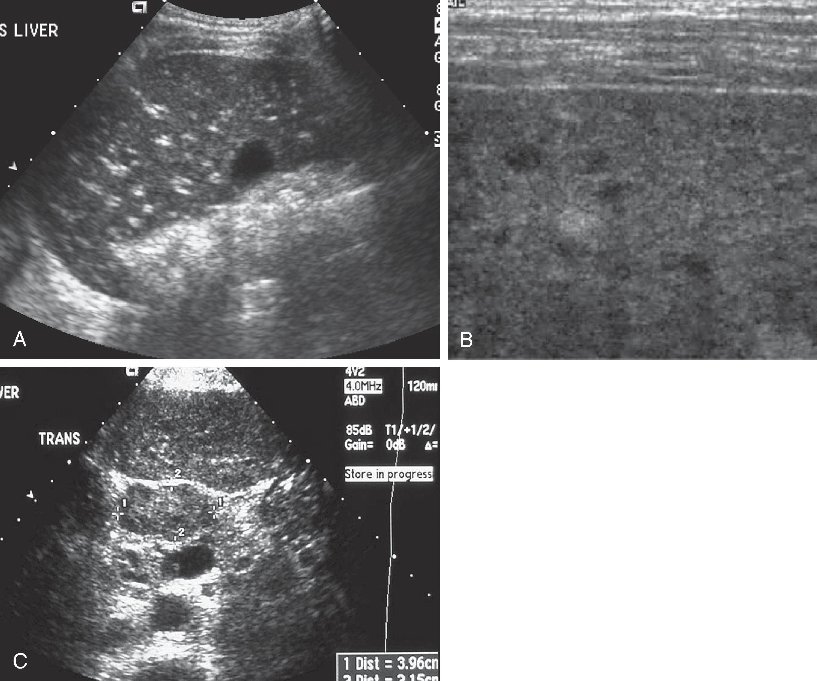 Fig. 56.4, Hepatitis: sonographic features.