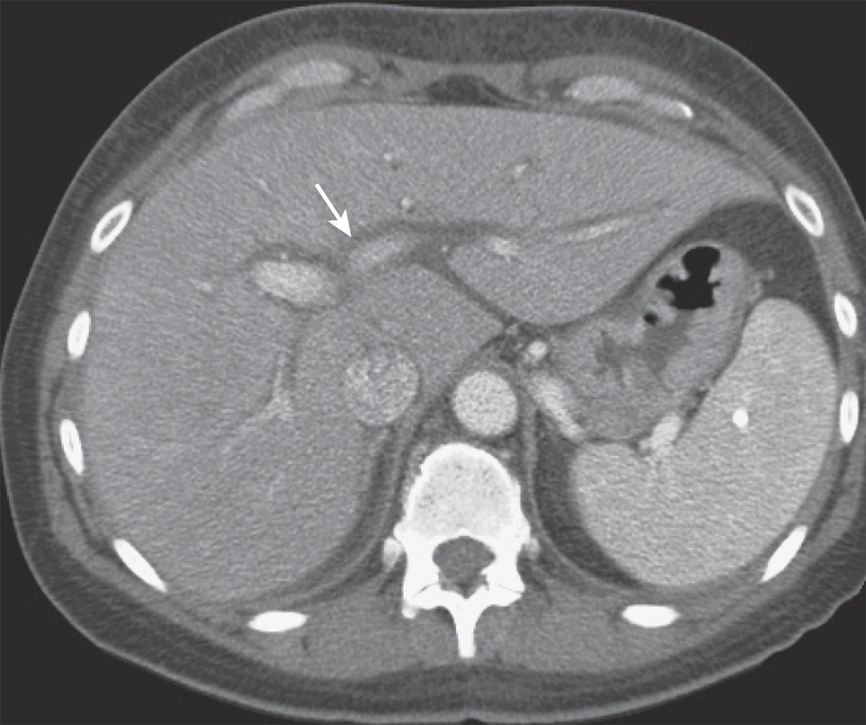 Fig. 56.5, Acute hepatitis: computed tomography (CT) findings.