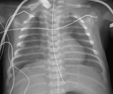 Figure 56.1, Alveolar capillary dysplasia/misalignment of the pulmonary veins in a full-term newborn.