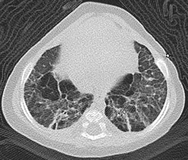 Figure 56.2, Bronchopulmonary dysplasia (alveolar growth disorder) in a 5-month-old, ex-28-week premature female.