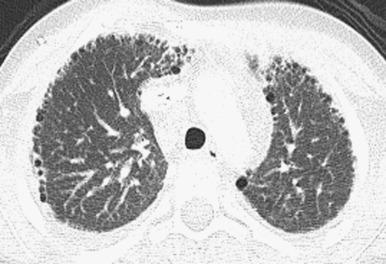 Figure 56.3, Alveolar growth disorder related to trisomy 21 in a 10-year-old.