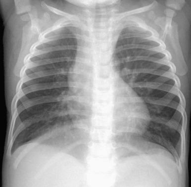 Figure 56.7, Neuroendocrine cell hyperplasia of infancy in a 15-month-old.