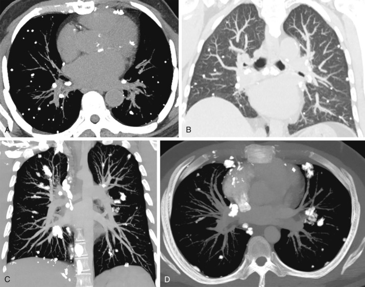 Figure 26.1, (A and B) Remote granulomatous infection in a 70-year-old man from the southern United States with numerous randomly distributed pulmonary nodules in all lobes of the lungs. (A) Axial maximum intensity projection (MIP) reformatted image with lung windows shows numerous completely calcified pulmonary nodules without associated visible soft tissue components. Calcified peribronchial lymph nodes are also present. (B) Coronal CT image with lung windows shows the random distribution of the nodules. No spatial gradient of distribution is seen. Other images showed multiple calcified nodules in the spleen and liver. The appearance is typical for a prior granulomatous infection such as histoplasmosis. (C and D) Osteosarcoma metastases in a 25-year-old man with osteosarcoma of the femur. MIP CT images with bone windows show calcified nodules, lymph nodes, and pleural metastases bilaterally. Although the larger nodules have associated soft tissue, the soft tissue is not visible within many of the smaller nodules, possibly causing confusion with benign patterns of calcification (e.g., as in calcified granulomas).