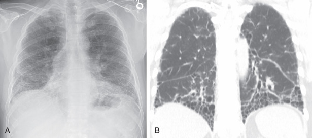 FIGURE 18.1, Usual interstitial pneumonitis on radiography (A) and computed tomography (B) . Posteroanterior chest radiograph (A) demonstrates low lung volumes and basilar-preponderant lung reticulation in this patient with idiopathic pulmonary fibrosis. Coronal image from noncontrast chest CT (B) from another patient demonstrates basilar and peripheral preponderant pulmonary fibrosis characterized by reticulation, traction bronchiectasis and bronchiolectasis, and exuberant honeycombing consistent with usual interstitial pneumonitis.