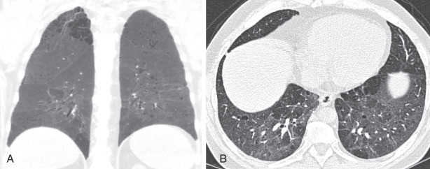 FIGURE 18.11, Desquamative interstitial pneumonitis on chest computed tomography (CT). Coronal minimum intensity projection image (A) demonstrates basilar-preponderant ground-glass opacity consistent with desquamative interstitial pneumonitis. Emphysema is noted primarily within the upper lobes in centrilobular, confluent, and paraseptal distributions, indicating a smoking history. Axial image from noncontrast chest CT image (B) from another patient demonstrates diffuse ground-glass opacity with superimposed microcystic abnormality highly suggestive of desquamative of interstitial pneumonitis in this long-time smoker.