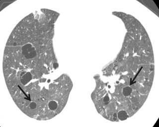 FIGURE 18.12, Lymphocytic interstitial pneumonitis on chest computed tomography (CT). Axial image from noncontrast chest CT demonstrates multiple cysts within the lower lobes in a peribronchovascular distribution as indicated by the eccentric pulmonary artery branches (arrows) . This patient had an underlying diagnosis of Sjögren syndrome, which is a common cause of lymphocytic interstitial pneumonitis in adults.