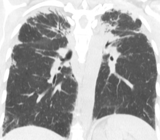 FIGURE 18.13, Idiopathic pleuroparenchymal fibroelastosis on chest computed tomography (CT). Coronal image from noncontrast chest CT demonstrates exuberant by apical pleural parenchymal scarring in this patient with idiopathic pleuroparenchymal fibroelastosis.