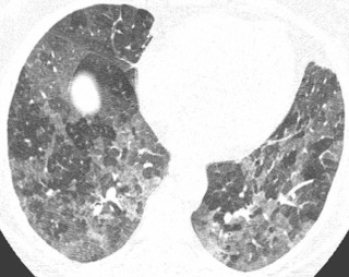 FIGURE 18.15, Hypersensitivity pneumonitis (HP) on expiratory chest computed tomography (CT). Axial image from expiratory phase chest CT demonstrates three distinct different densities demarcated by the margins of secondary pulmonary lobule, consistent with the head cheese sign, which is highly suggestive of HP. The most hypodense areas represent areas of air trapping, the intermediate-density regions represent normal lung, and the most hyperdense areas represent localized areas of lymphocytic inflammation.
