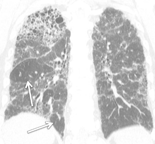 FIGURE 18.16, Fibrotic hypersensitivity pneumonitis (HP) on chest computed tomography (CT). Coronal image from noncontrast chest CT demonstrates asymmetric right greater than left, upper lung–predominant pulmonary fibrosis characterized by reticulation, traction bronchiectasis and bronchiolectasis, and early subpleural honeycombing. Mosaic attenuation within the lower lobes is consistent with air trapping in this patient with HP. Arrows indicate areas of air trapping.