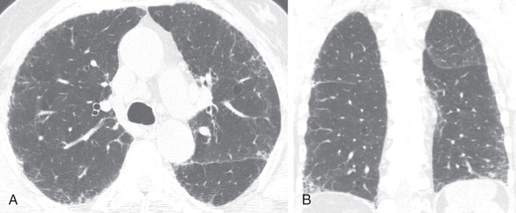 FIGURE 18.2, Possible usual interstitial pneumonitis pattern on chest computed tomography (CT). Axial (A) and coronal (B ) images from noncontrast chest CT demonstrate basilar- and peripheral-preponderant pulmonary fibrosis characterized by reticulation and traction bronchiectasis as well as traction bronchiolectasis without honeycombing consistent with a possible usual interstitial pneumonitis pattern.