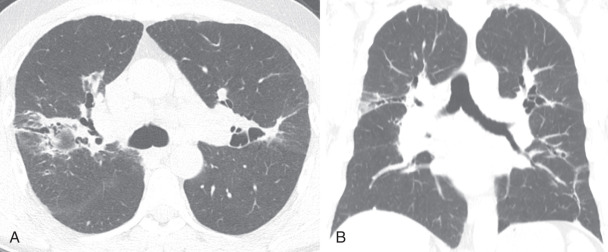 FIGURE 18.3, Inconsistent with usual interstitial pneumonitis pattern on chest computed tomography (CT). Axial (A) and coronal (B) images from noncontrast chest CT demonstrate mid and central-lung–predominant pulmonary fibrosis characterized by reticulation, ground-glass opacity, and traction bronchiectasis inconsistent with usual interstitial pneumonitis. The patient was shown to have sarcoidosis.