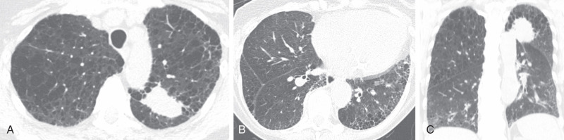 FIGURE 18.4, Combined pulmonary fibrosis and emphysema on chest computed tomography (CT). Axial ( A and B ) and coronal (C) images from noncontrast chest CT demonstrate upper lung centrilobular, paraseptal, and confluent emphysema with associated basilar-preponderant pulmonary fibrosis consistent with usual interstitial pneumonitis. There is also a mass within the left upper lobe, highly suggestive of primary lung cancer. Patients with combined pulmonary fibrosis and emphysema are at increased risk for development of lung malignancy.