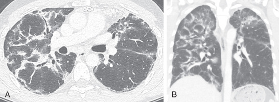 FIGURE 18.7, Organizing pneumonia on chest computed tomography (CT). Axial (A) and coronal (B) images from noncontrast chest CT demonstrate right lung–predominant, perilobular consolidation and mild ground-glass opacity highly suggestive of organizing pneumonia related to stem cell transplantation and chronic graft-versus-host disease.