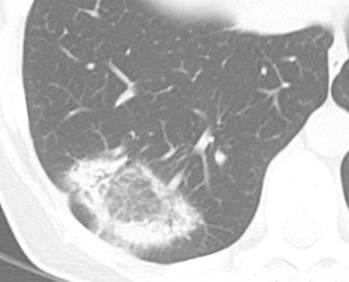 FIGURE 18.8, Organizing pneumonia on chest computed tomography (CT). Axial image from noncontrast chest CT demonstrates right lower lobe focus of ground-glass opacity and reticulation with a near complete circumferential ring of consolidation (reverse halo sign). This sign is not pathognomonic for organizing pneumonia but is highly suggestive of the diagnosis.