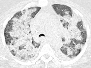 FIGURE 18.9, On computed tomography, there are diffuse or dependent ground-glass opacities and consolidation.