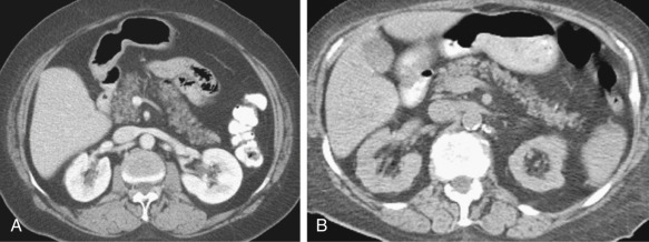 Figure 51-11, Fatty replacement of pancreas. A and B, Axial computed tomography images in two different elderly patients aged 75 and 84 years, respectively, show variable degree of fatty replacement with prominent pancreatic lobulations and mild atrophy.
