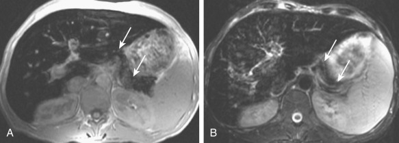 Figure 51-12, Hemochromatosis. Axial T1-weighted (A) and T2-weighted fat-suppressed gradient recalled echo (B) magnetic resonance imaging reveals diffusely hypointense pancreas (arrows) and liver, compared with the muscles, secondary to iron deposition. Spleen is shown as normal signal intensity.