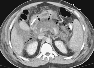 Figure 51-2, Acute pancreatitis. Axial computed tomography image reveals a swollen, edematous head and body of pancreas (arrows) with peripancreatic fat stranding (long black arrow at lower left) and fluid collection (arrowheads).