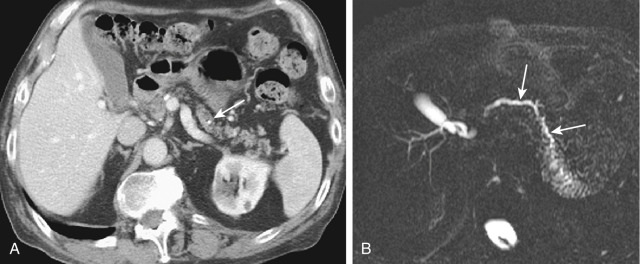 Figure 51-3, Chronic calcifying pancreatitis. A, Axial computed tomography image shows a small and atrophic pancreas. The pancreatic duct visualized in the region of the body is dilated with an intraductal calcification (arrow). B, Axial two-dimensional magnetic resonance cholangiopancreatography image in a different patient reveals a beaded irregular pancreatic duct (arrows).